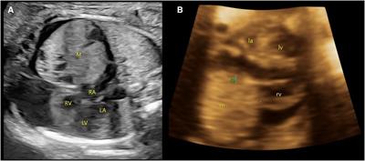 A giant teratoma in the anterior mediastinum found prenatally: A case report